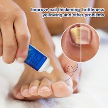 Nail Fungus Removal cream Treatment Onychomycosis Paronychia Product Anti Nail Nail Feet Toe Fungal Infection Care Gel L0E0 2024 - buy cheap