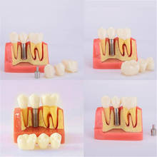 Dental Teeth Model Dental Teach Implant Analysis Crown Bridge Demonstration Coummnication Teeth Model 2024 - buy cheap