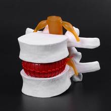 Human Anatomical Lumbar Disc Herniation Model Learn Aid Anatomy Instrume Q1JC 2024 - buy cheap