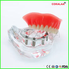 1 pcs Preparation model dental implant model dentures teeth model for dentists learning silver rod 2024 - buy cheap