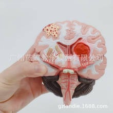 1:1 Humans Brain Disease Model Brain Anatomical Model Neurosurgery Cerebral Hemorrhage  Pathological Medical Teaching Model 2024 - buy cheap