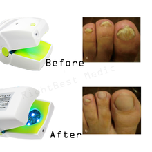 Rechargeable Nail Fungus Laser Treatment Device Onychomycosis Cure Treat Nail Fungus and Infections 2024 - buy cheap