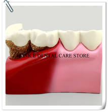 Modelo de enseñanza Dental M4029, modelo de enseñanza Dental que muestra patologías, Caries/Canal radicular Dental, modelo de implante educativo 2024 - compra barato