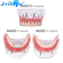 Dentes de implante dental modelo demonstração restauração overdenture claro com 2/4 implantes maxilar superior inferior mndibular 2024 - compre barato