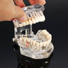 Dental Restoration Teeth Model Transparent Implant DiseDental Implant Disease Teeth Model With Restoration Bridge Tooth Dentist 2024 - buy cheap