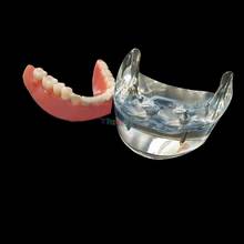 1Pc High QualityDental 4 Implant Teeth Study Model Overdenture Inferior Demo Model 2024 - buy cheap