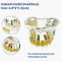 Модель верхней части зубного имплантата с мостиком и карисом, модель для стоматологического исследования и обучения зубов 2024 - купить недорого