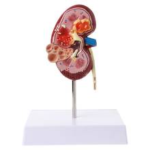 Life Size Human Model Diseased Model Anatomical Anatomy Diseased Pathological Stone Organ Kidney Model Teaching Supplies 2024 - buy cheap
