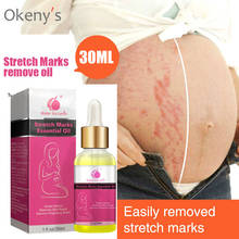 100% Herbal Natural 30ml Skin Care Ance Stretch Marks Remover Oil Cream Remove Body Stretch Marks Uneven Skin Tone Purcellin Oil 2024 - buy cheap