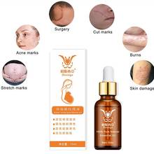 Stretch Marks Remover Essential Oil Eliminate Pregnancy Winkle Firming Treatment Repair Anti Maternity Skin Scars S0G1 2024 - buy cheap