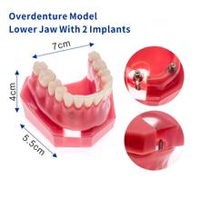 Inferior para implante dentário overdentdentadura modelo de 6007 dentes modelo de 2 implantes 2024 - compre barato