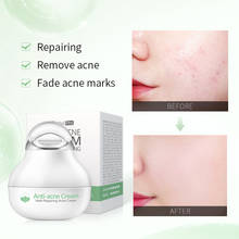 Anti-acne Cream Blackhead Acne Cream Repair Gel Oil Control Shrink Pores Scar Facial Skin Care Whitening Beauty & Health TSLM1 2024 - buy cheap