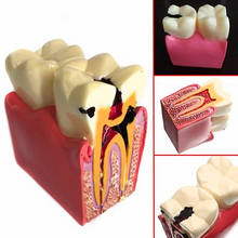 Modelo de dentes odontológicos, modelo de 6 vezes para comparação de próteses dentárias, modelos de dentes, estudo e pesquisa para odontologia 2024 - compre barato