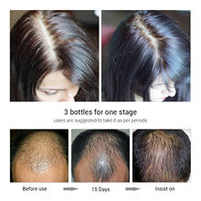 Эссенция для роста волос спрей для предотвращения облысения консолидация против выпадения волос сильное питание корней волос Восстановитель роста волос S001 2024 - купить недорого