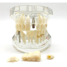 Modelo para ensino de implante dentário, modelo para dentes com ponte de restauração, ferramenta para ensino de dentista 2024 - compre barato