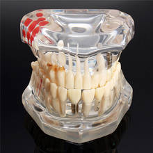 Dental Disease Teeth Model With Restoration Bridge Tooth Dentist For Medical Science Dental Teaching Model Teaching Study 2024 - buy cheap