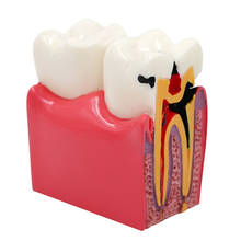 Modelo de dentes desbancados dentários, modelo de ensino de anatomia dos dentes modelo de 6 vezes, comparação de caries, estudo, pesquisa 2024 - compre barato