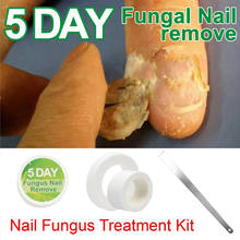 Chinese Medicine Herbs Toe Nail Fungus Treatment Anti Fungal Nail Infection Essence Nail Treatment Removal Nail Care Lotion 2024 - buy cheap