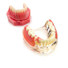 Modelo de restauración de implantes dentales, puente extraíble, modelo de investigación para enseñanza de la dentadura, para estudiantes de odontología 2024 - compra barato