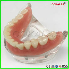 Good quality 4 nails Mandibular model dental lower jaw implant model dentures teeth model for dentists learning 2024 - buy cheap