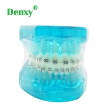 Dental Study teeth Model Orthodontic Treatment Model with Metal bracket Education Teeth model  dental brace model 2024 - buy cheap