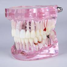Implante y restauración de dientes M2001, modelo de caries dentales, modelo de dientes, enfermedad de implante, con corona de puente de restauración 2024 - compra barato