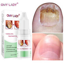 OMY LADY Fungal Nail Treatment Feet Care Serum Nail Foot Nail Fungus Removal Gel Anti Infection Paronychia Onychomycosis Care 2024 - buy cheap