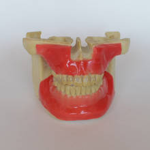 Modelo de enseñanza Dental, implante de tornillo de anclaje ortodóntico, modelo de práctica con tejido #203101 2024 - compra barato