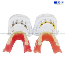 1 pc x high quality Resin Coverage dental implant model dentures Removable teeth model for dentist study Deasin dentistry 2024 - buy cheap