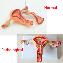 Medical Science Normal/Pathological Uterus Ovary Anatomical Model Anatomy Cross Section Medical teaching supplies 2024 - buy cheap