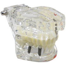 2 pcs Dental Implant Disease Teeth Model With Restoration Bridge Tooth Dentist For Medical Science Dental Disease Teaching Study 2024 - buy cheap