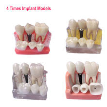 1PC Dental Study Educational Demenstration Model 4 Times Implant Teaching Models 2024 - buy cheap