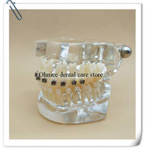 Modelo de dentes dentais com suporte de metal e suporte de cerâmica/suporte ortodôntico dental m3003 2024 - compre barato