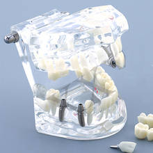 Dental Caries Teeth Model M2001 Implant Disease Teeth Model With Restoration Bridge Crown Dental Tooth Model Mariland Bridge 2024 - buy cheap