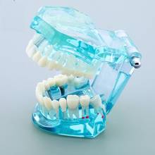 Dental Disease Teeth Model With Restoration Bridge Crown Dental Model Mariland Bridge Implant and Restoration Model with Nerve 2024 - buy cheap