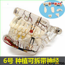 dental teeth model Transparent pathological implant nerve model Repair model Teaching demonstration model 2024 - buy cheap