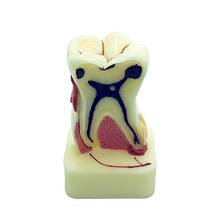 Modelo de dentes 4 vezes patologia modelo odontológico modelo doença dentária equipamento educacional dentário 2024 - compre barato