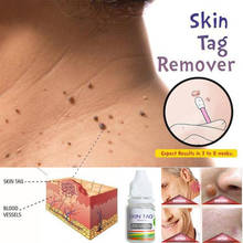 Skin Tag Remover 12 Hours Tu Kill Medical Tu Kill Remover Skin Tag Mole Genital Wart Remover Foot Corn Blackhead Remover 10ml 2024 - buy cheap