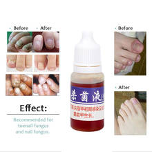 Tratamiento de uñas para reparación de uñas, suero nutritivo para el cuidado de mano y pie, elimina la onicomicosis del dedo del pie, 15ml, TSLM1 2024 - compra barato