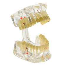 Modelo de dentes da doença do implante com ponte da restauração dentista para o estudo de ensino da doença da ciência 2024 - compre barato