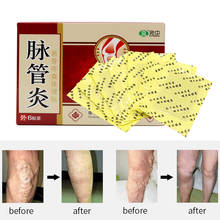 24PCS Spider Veins Varicose Treatment Plaster Varicose Veins Cure Patch Vasculitis Natural Solution Herbal Patches 2024 - buy cheap