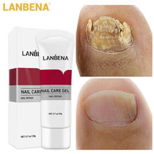 LANBENA Nail Fungus Removal Crema Onychomycosis Fungal Nail Treatment Paronychia Anti Infection Feet Toe Fungal Nail Care Gel 2024 - buy cheap