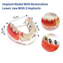 Modelo para implante de dentaduras e próteses dentárias, modelo com estrutura odontológica de 6006 dentes 2024 - compre barato