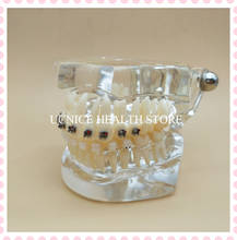 Modelo dental dos dentes ortodônticos com suporte m3003/educação modelo dos dentes m3003/modelo dental da cinta 2024 - compre barato