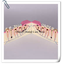 Periodontal disease teeth model M4009/dental teaching model Molar cross section study teeth model 2024 - buy cheap