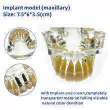 Dental Upper/Lower Implant model with bridge and caries implant Mandibular Teeth 2024 - buy cheap