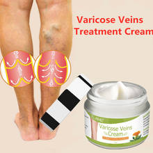 50G Varicose Veins Treatment Cream Varicosity Angiitis Remedy Ointment Relief Veins Pain Phlebitis legs Varicose Veins Cream 2024 - buy cheap
