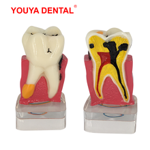 Modelo dental resina 4 vezes transparente molar anatomia dentes modelagem com nervos ciência médica dentista oral produtos odontologia 2024 - compre barato