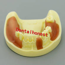 Implante de mandíbula inferior Dental, modelo de dientes Typodont con gencía, nueva práctica 2024 - compra barato