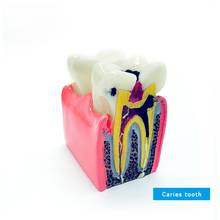 Modelo dental dos dentes modelo da cárie do modelo dental para o modelo da demonstração da doença dos dentes 2024 - compre barato